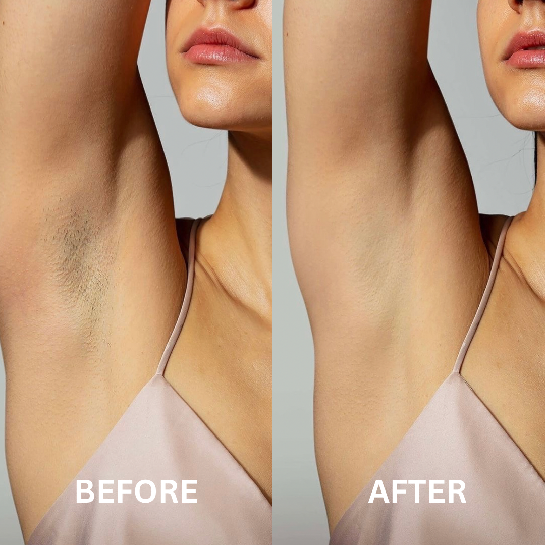 The before and after results of using SilkenRay™ IPL hair removal at home.